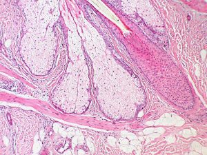 Base_of_Pilosebaceous_Unit_10x vestigial