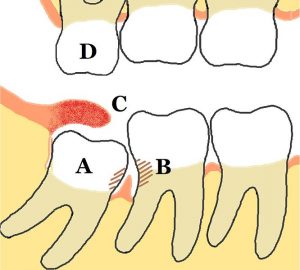 Lower_mandibular_third_molar_impaction_pericoronitis_diagram vestigial 